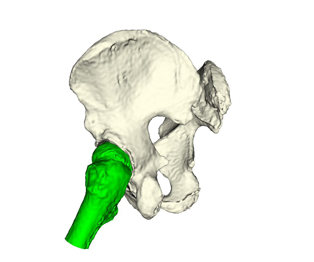 Intraop. Meth. 3 Pelvis and Femurs 3D Viz 2